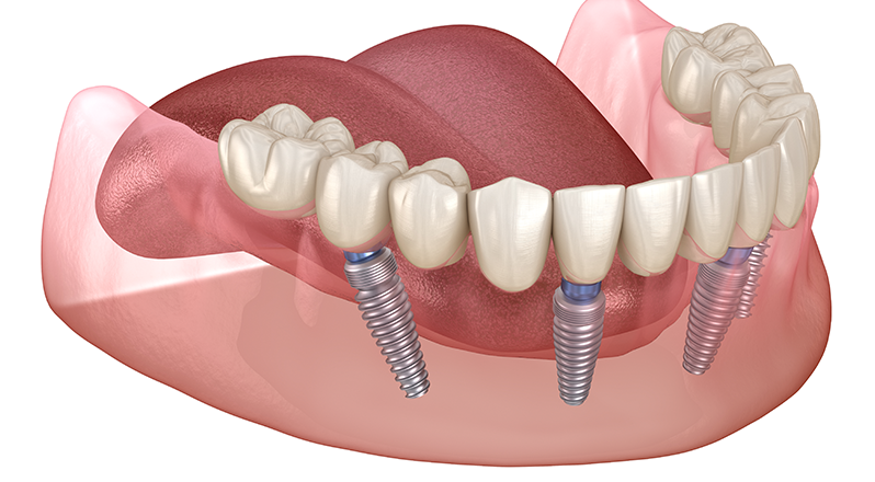 Treatment Banner thumb : Welling Dental