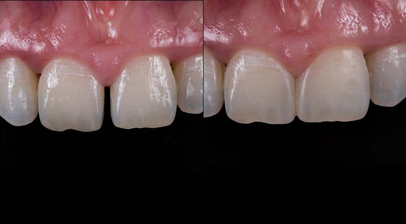 Treatment Banner thumb : Welling Dental