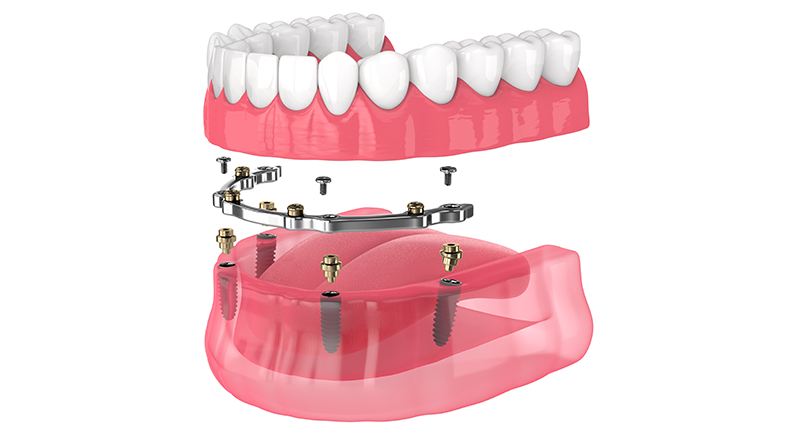 implantretained-thumbinner Treatment Banner thumb : Welling Dental