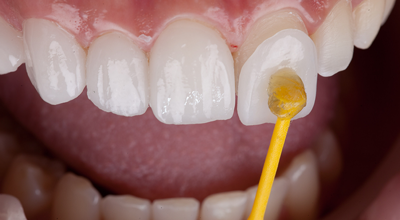 Treatment Banner thumb : Welling Dental