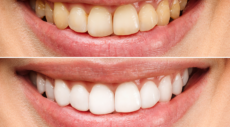 Treatment Banner thumb : Welling Dental